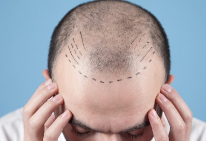 caucasian-bald-man-before-hair-transplantation.jpg_s1024x1024wisk20cB5MVGxBmaGRXUujQPFEiE_ke0EsOOcNF9A-Lg2CPw8g